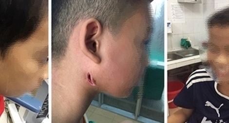 Hai anh em ruột ở Hà Nội tử vong do nhiễm Whitmore